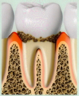 経度の歯周病画像