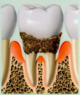 重度の歯周病画像