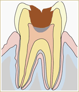 むし歯治療画像3